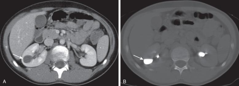 Figure 113.13, Calyceal diverticulum in a 10-year-old girl.