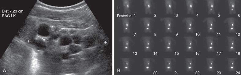 e-Figure 113.2, A multicystic dysplastic kidney in a 6-month-old boy.