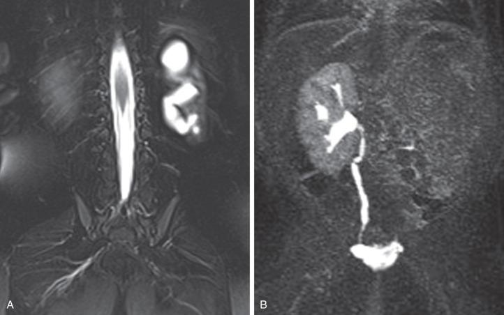 e-Figure 113.3, Multicystic dysplastic kidney and MRI, hydronephrotic form.