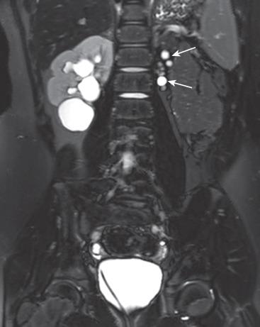 e-Figure 113.4, Involuting multicystic dysplastic kidney.