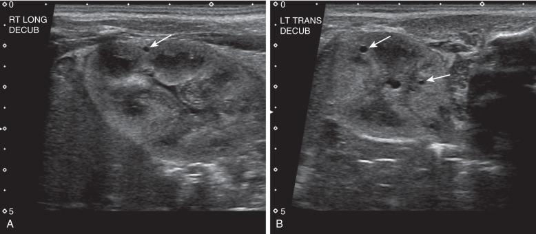 Figure 113.5, Autosomal dominant polycystic kidney disease in a newborn.