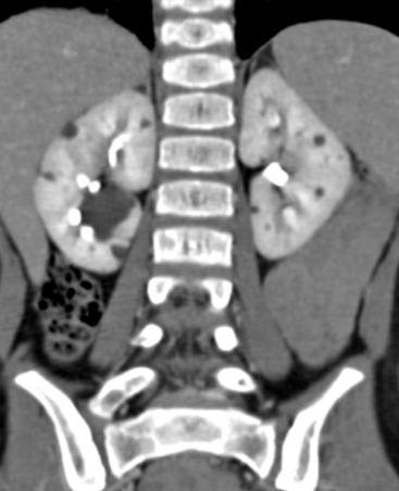 Figure 113.6, Autosomal dominant polycystic kidney disease in an 8-year-old girl.