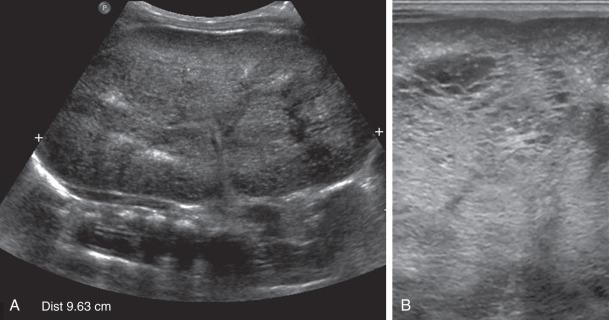 Figure 113.8, Autosomal recessive polycystic kidney disease in a newborn girl.