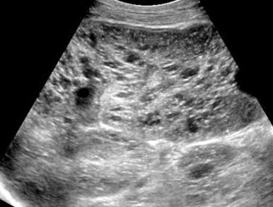 Figure 113.9, Autosomal recessive polycystic kidney disease in a 6-month-old boy presenting with acute renal failure and bilateral flank masses.