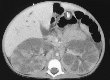 Figure 113.10, Autosomal recessive polycystic kidney disease and CT.