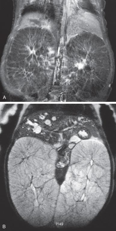 Figure 113.11, Autosomal recessive polycystic kidney disease and MRI.