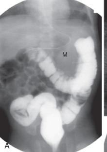 Figure 99.1, Gastric duplication cyst.