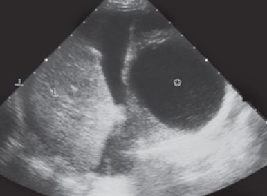 e-Figure 99.3, Ruptured gastric duplication cyst.