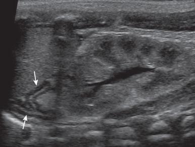 Figure 121.1, Normal left adrenal in a 1-day-old newborn.