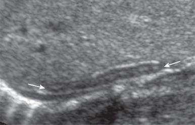 Figure 121.2, Discoid adrenal gland in a patient with right renal agenesis.