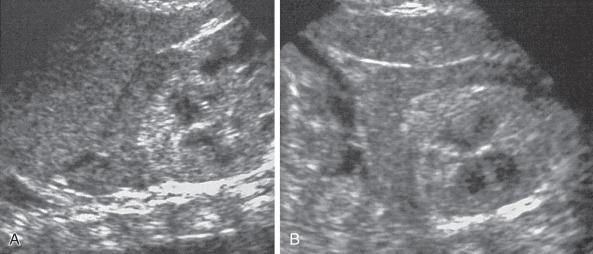 Figure 121.4, Adrenal congestion in an 8-day-old full-term boy with necrotizing enterocolitis, cardiovascular collapse, and multiorgan failure.