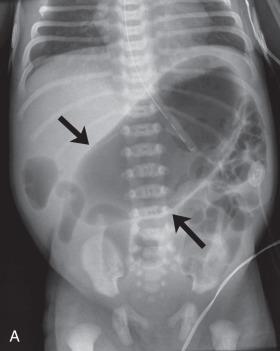 Figure 105.1, Colonic atresia.