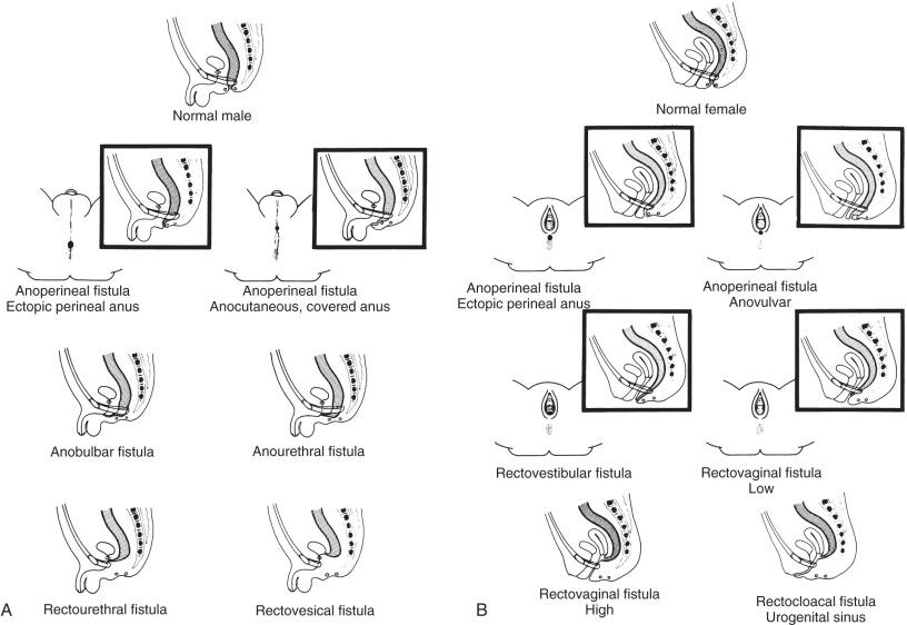 Figure 105.2, Physical examination findings in boys and girls with anorectal malformations.