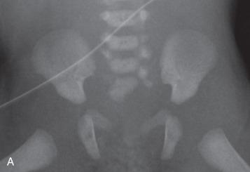 Figure 105.3, Bony abnormalities in patients with anorectal malformations.