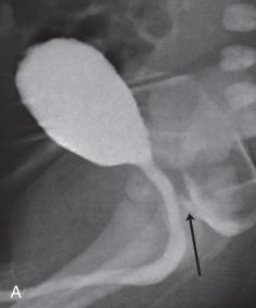 Figure 105.4, Anorectal malformation: preoperative imaging.