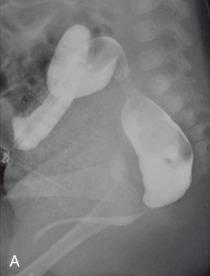 e-Figure 105.5, Anorectal malformation (ARM).