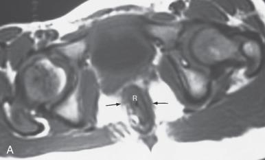 Figure 105.6, Anorectal malformation after definitive repair.