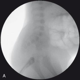 e-Figure 105.7, Rectal atresia.