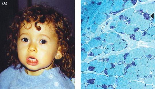 Figure 28.4, Case example of nemaline myopathy. ( A ) Photograph of patient MLL at age 3. The classical facial appearance, particularly of lower facial weakness, of NM is depicted. ( B ) Photomicrograph of the muscle biopsy from patient MLL. Abundant nemaline rods (arrowhead) are present, confirming the histopathologic diagnosis of nemaline myopathy. Stain=modified Gomori trichrome.