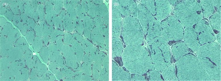 Figure 28.5, Nemaline myopathy. Light microscopy (Gomori trichrome stain) at low power ( A ) and high power ( B ). Multiple rods are present in most fibers. Note aggregation of rods under the sarcolemmal membrane.