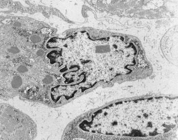 Figure 28.7, Nemaline myopathy. Electron micrograph showing intranuclear rod in a single nucleus. Rods are also present in the adjacent muscle fiber, where there is loss of the regular sarcomeric structure (×36,000).