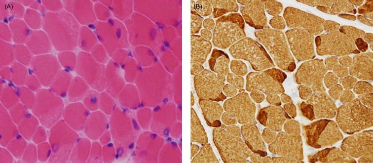 Figure 28.9, Cap myopathy. ( A ) Hematoxylin and eosin stain of a muscle biopsy with cap myopathy. Note the pale and granular areas that correspond to the caps. ( B ) Immunostaining with anti-myosin antibodies highlights the caps.