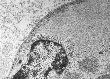 Figure 28.10, Actinopathy. A large perinuclear subsarcolemmal aggregate of thin, actin filaments. These aggregates may occur in association with typical nemaline myopathy (×36,400).