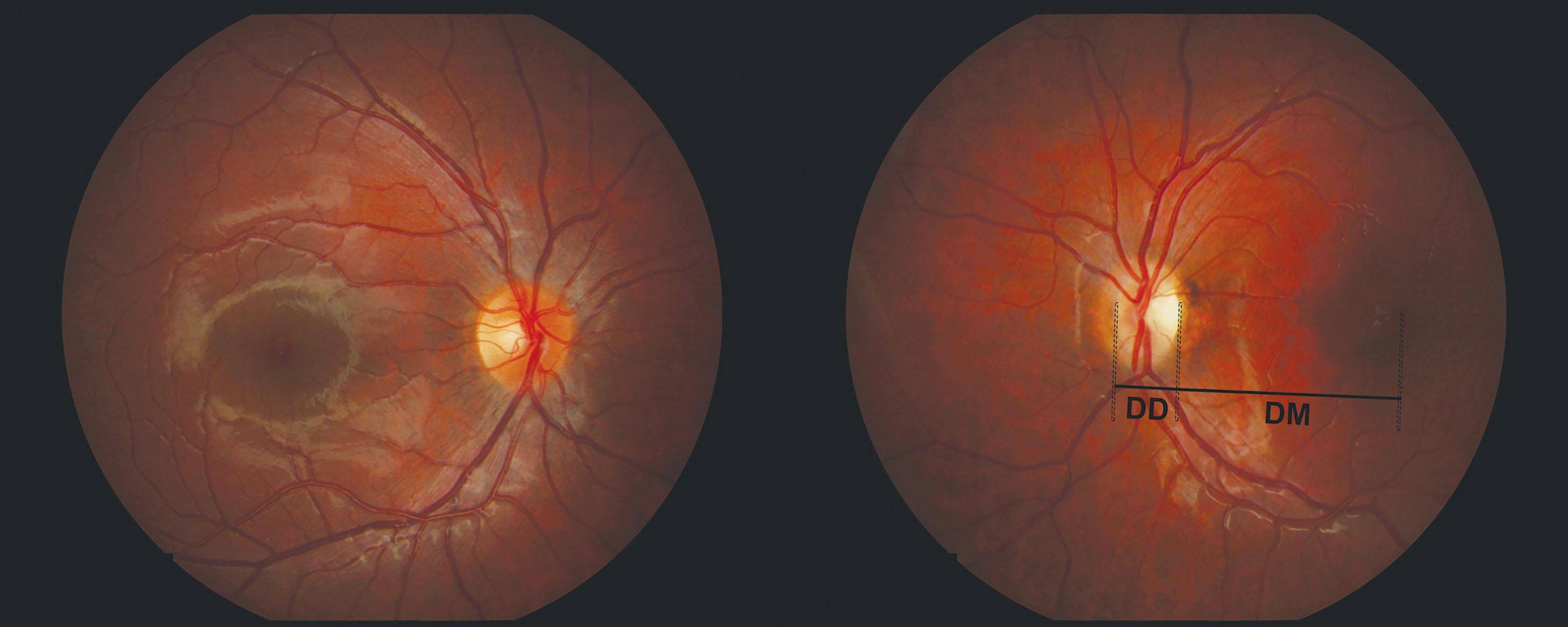 Fig. 53.1, Normal right optic nerve and hypoplastic left optic nerve in a 10-year-old child with unilateral optic nerve hypoplasia. A nasal peripapillary crescent of bare sclera is present in the left eye. The disc–macula to disc diameter (DM/DD) ratio measures 3.37.