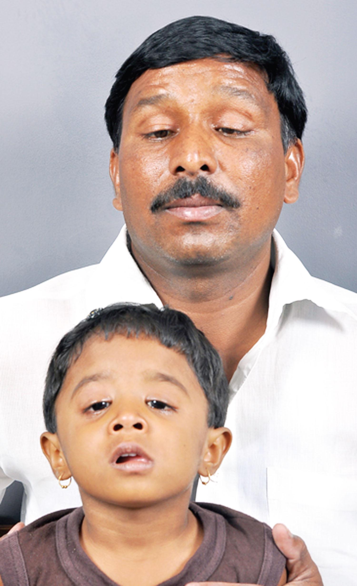 Fig. 84.1, Congenital fibrosis syndrome type I (CFEOM1) in a father and son. Because of their bilateral ptosis and deficient upgaze, both have adopted a head posture with the chin elevated.