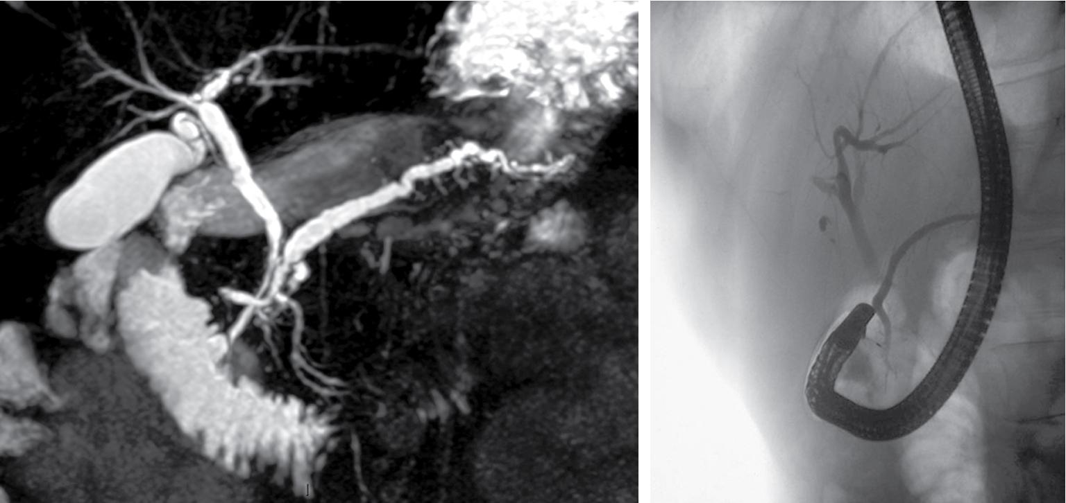 FIGURE 53.3, Imaging in pancreas divisum (PD).