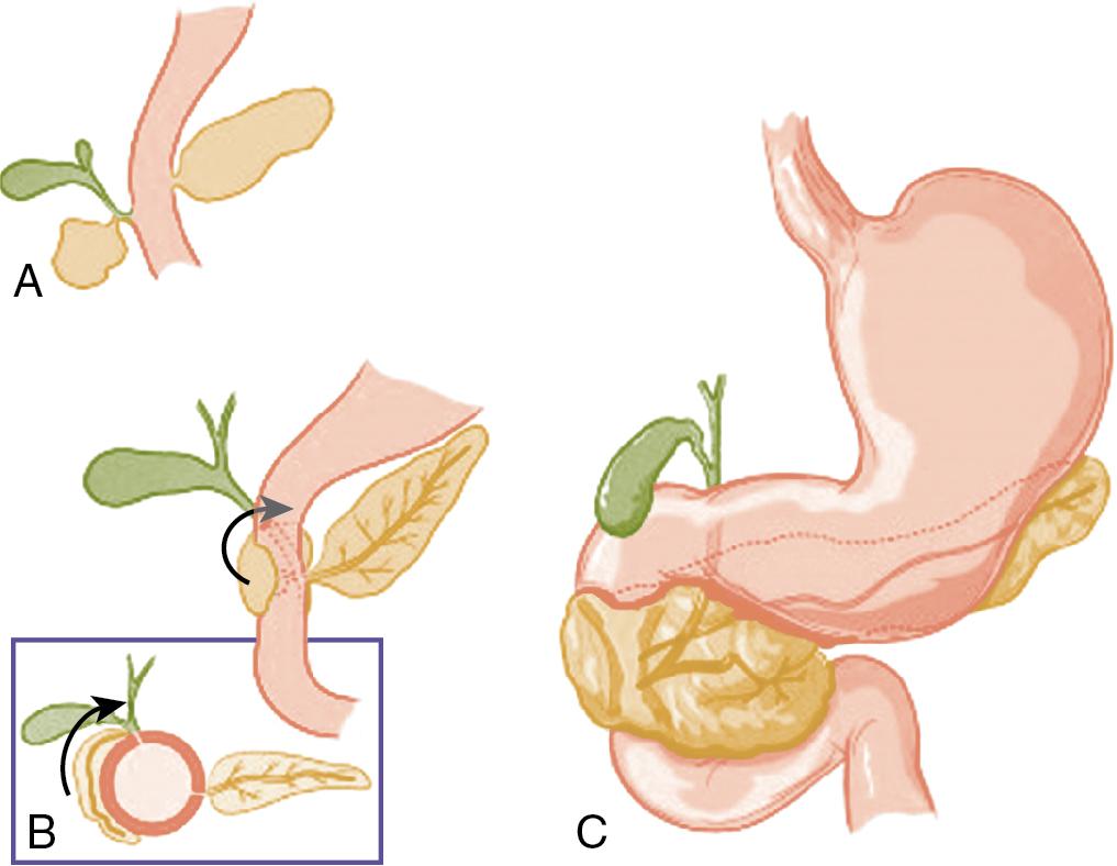 FIGURE 53.4, Embryologic development of annular pancreas.
