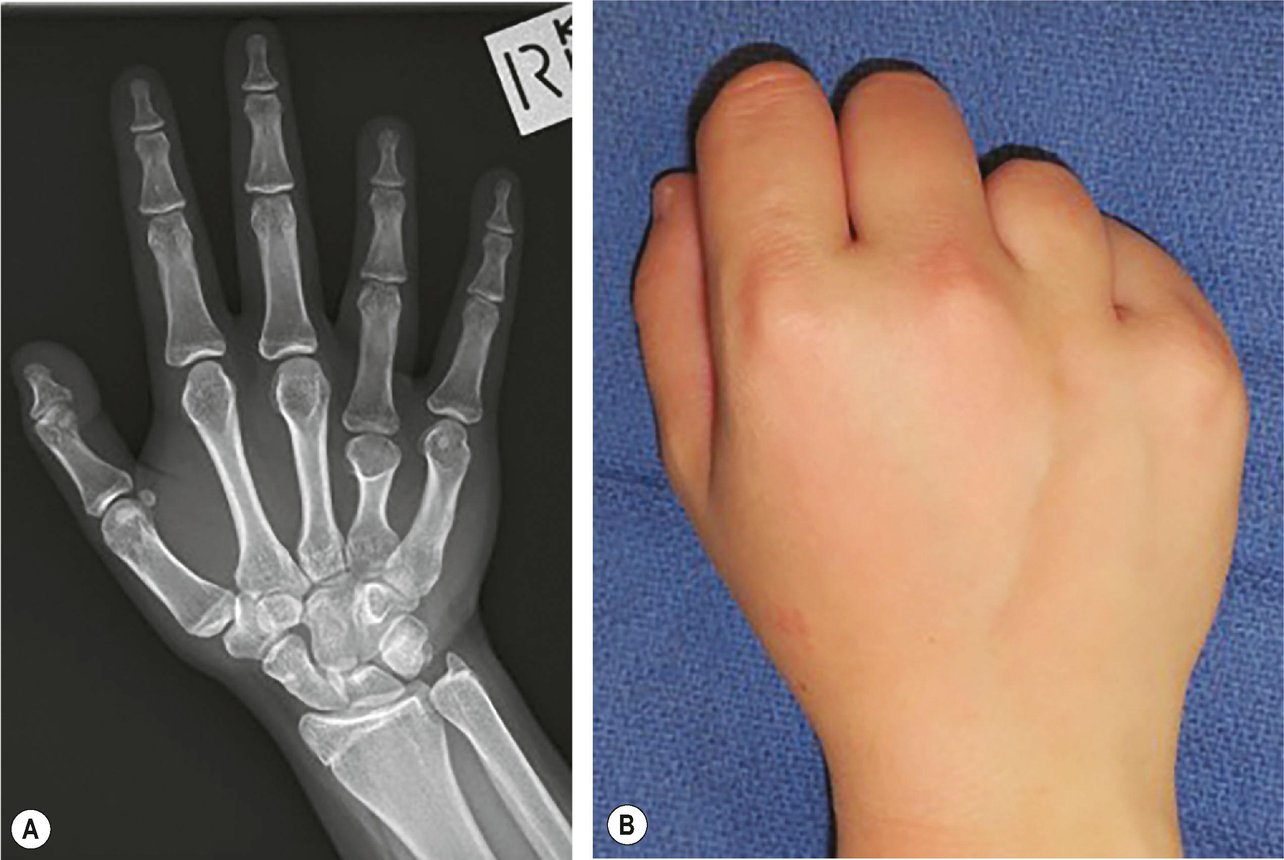 Figure 34.1, (A) Radiograph of right ring finger brachymetacarpia. (B) Altered knuckle contour, less prominent metacarpal head when making a fist.