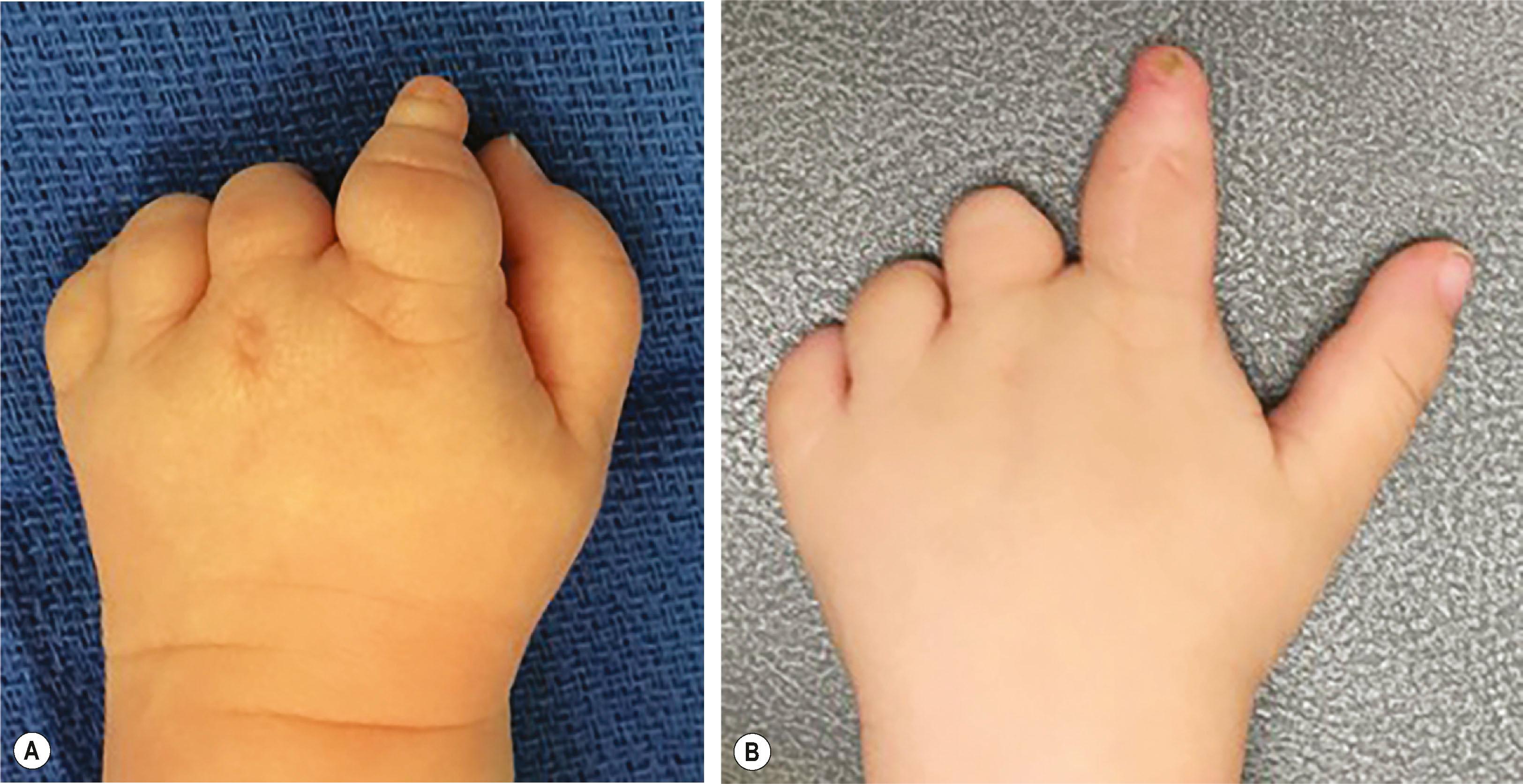 Figure 34.5, (A) Preoperative photograph oligodactylic symbrachydactyly. (B) Postoperative photograph after non-vascularized toe phalanx transfer to the index finger.