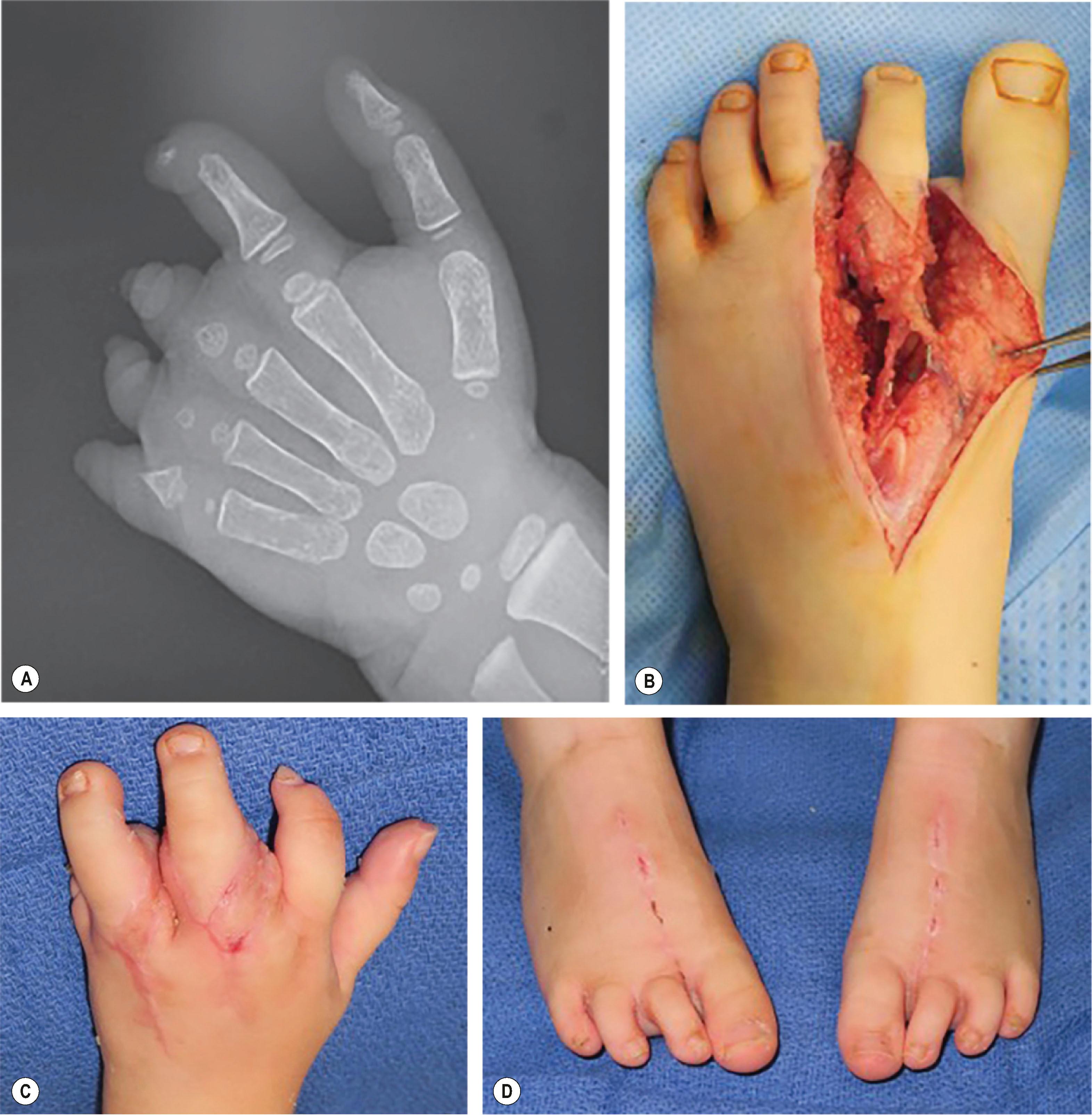 Figure 34.6, Patient with oligodactylic symbrachydactyly who underwent double free second toe-to-hand transfers for reconstruction of the middle and ring fingers. (A) Preoperative radiograph. (B) Intraoperative dissection of toe. (C) Postoperative photo of hand. (D) Postoperative photo of feet donor sites.