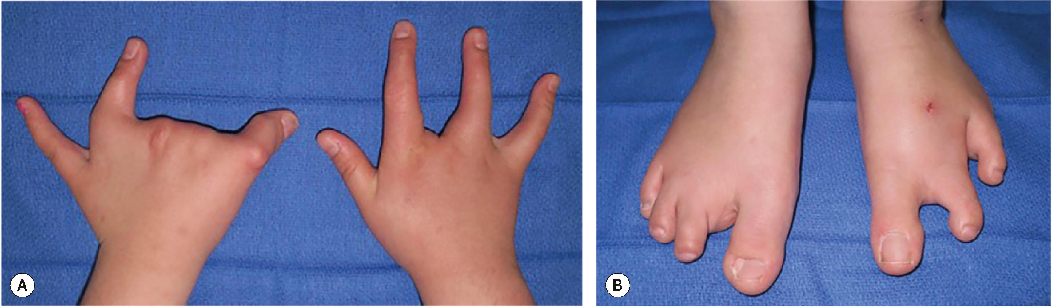 Figure 34.8, Patient with split hand foot malformation and (A) bilateral cleft hands and (B) bilateral cleft feet.