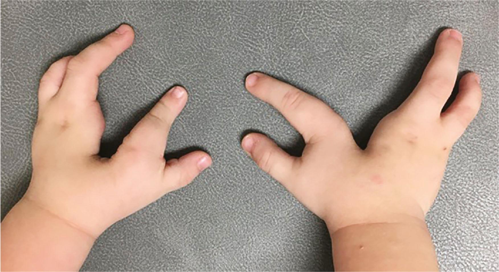 Figure 34.9, Bilateral cleft hands with a deep central V-shaped splits, ectrodactyly, and narrow first webspaces.