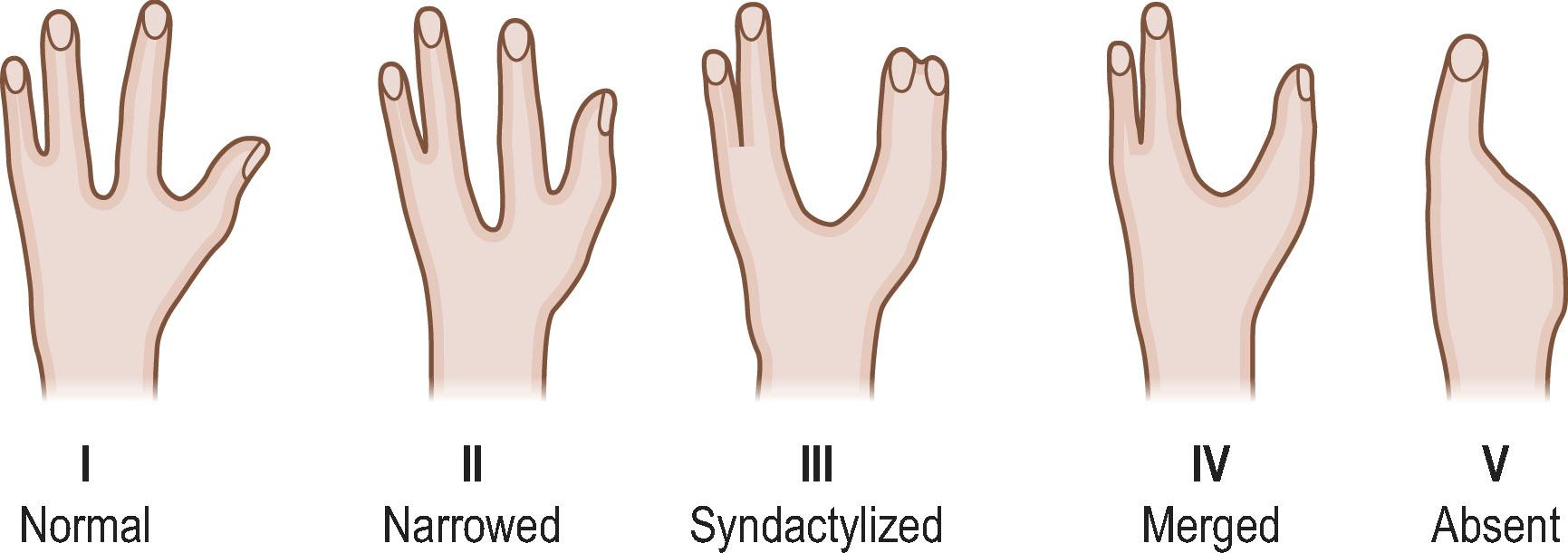 Figure 34.10, Schematic drawing of progressive narrowing of the thumb and first webspace in cleft hand.