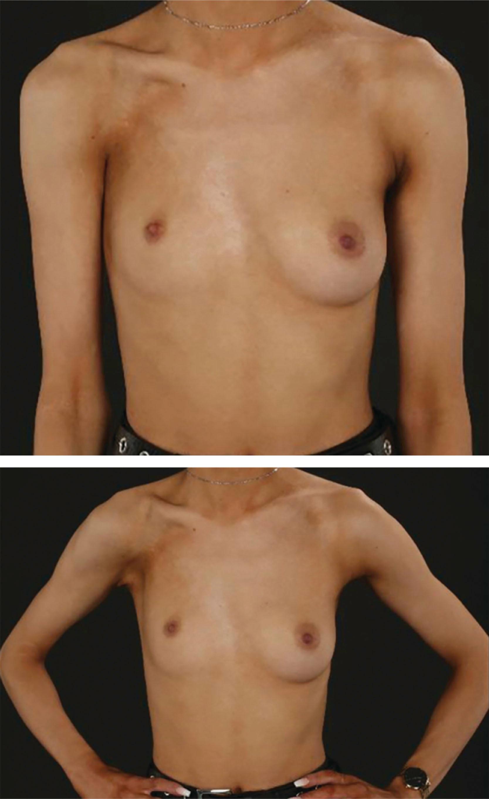 Figure 33.1, Thorax of a young woman with Poland syndrome. There is absence of the sternal head of pectoralis major (more obvious on when the arms are abducted), mammary hypoplasia, and a relatively small and superiorly displaced nipple areolar complex.