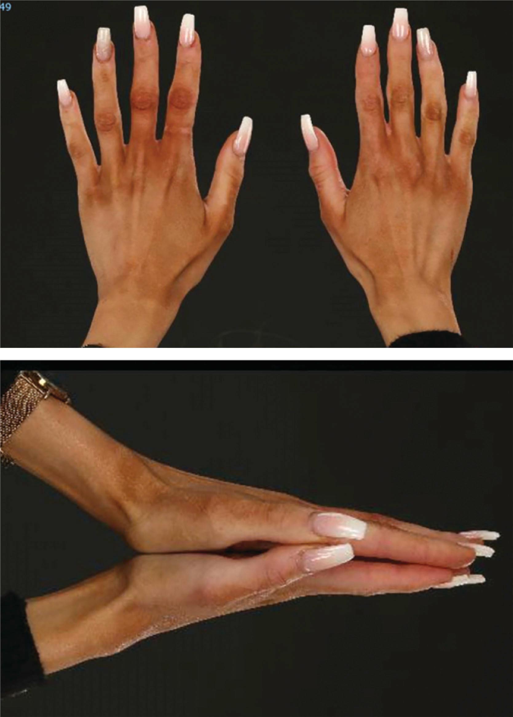 Figure 33.2, Appearance of hands of the patient from Fig. 33.1 . There is mild hypoplasia, and a very mild, proximal, incomplete syndactyly of the second webspace. There were no aesthetic or functional concerns from the patient’s point of view.