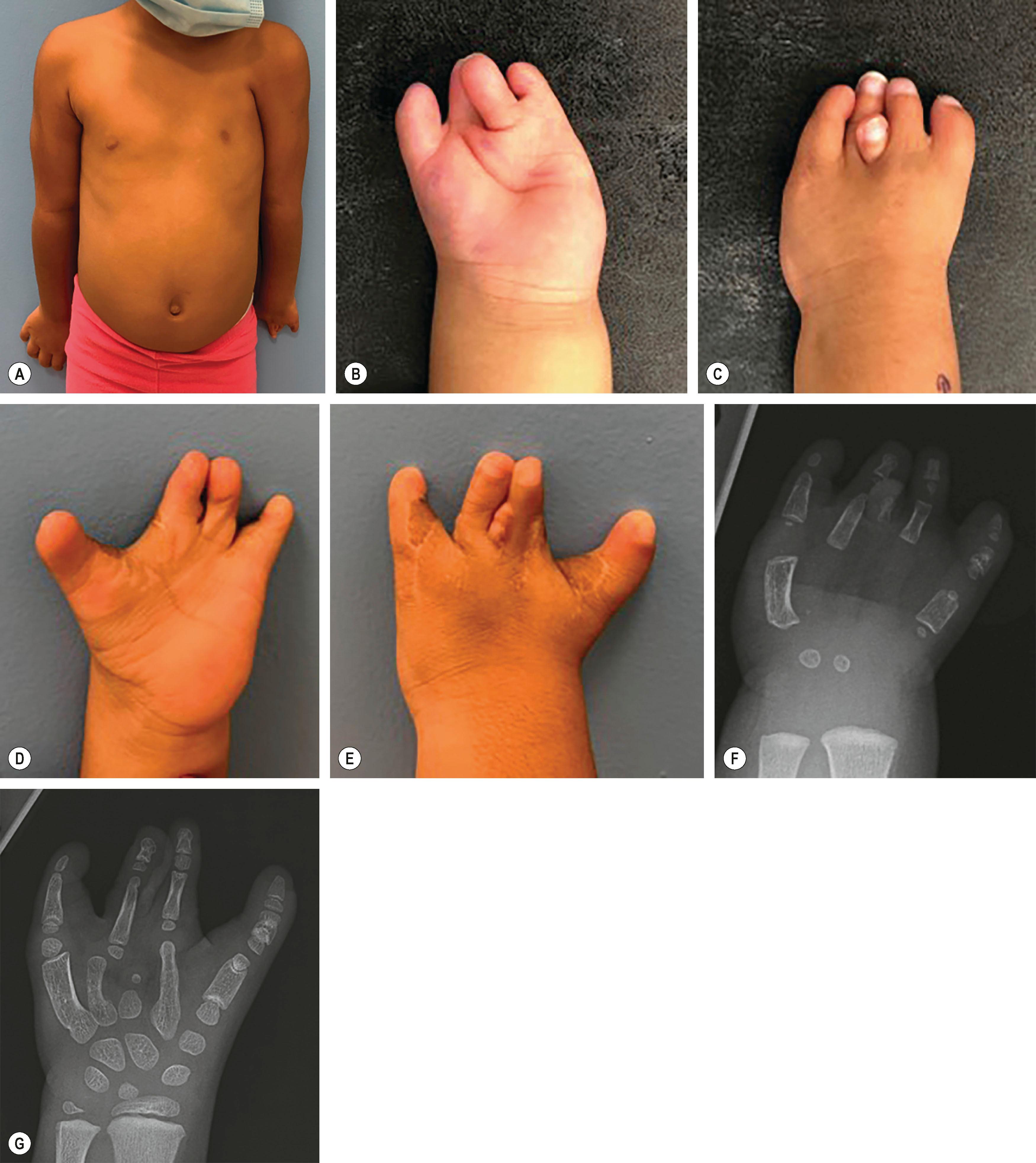 Figure 33.3, (A) A 5-year-old girl with Poland syndrome affecting development of the left chest wall and left-hand development (symbrachydactyly). (B,C) Appearance of the same patient’s left hand at 2 years of age. (D,E) Appearance of hand at 5 years of age, after reconstruction of 1st and 4th webspaces and removal of 3rd ray. (F,G) X-rays of affected hand corresponding to clinical pictures.