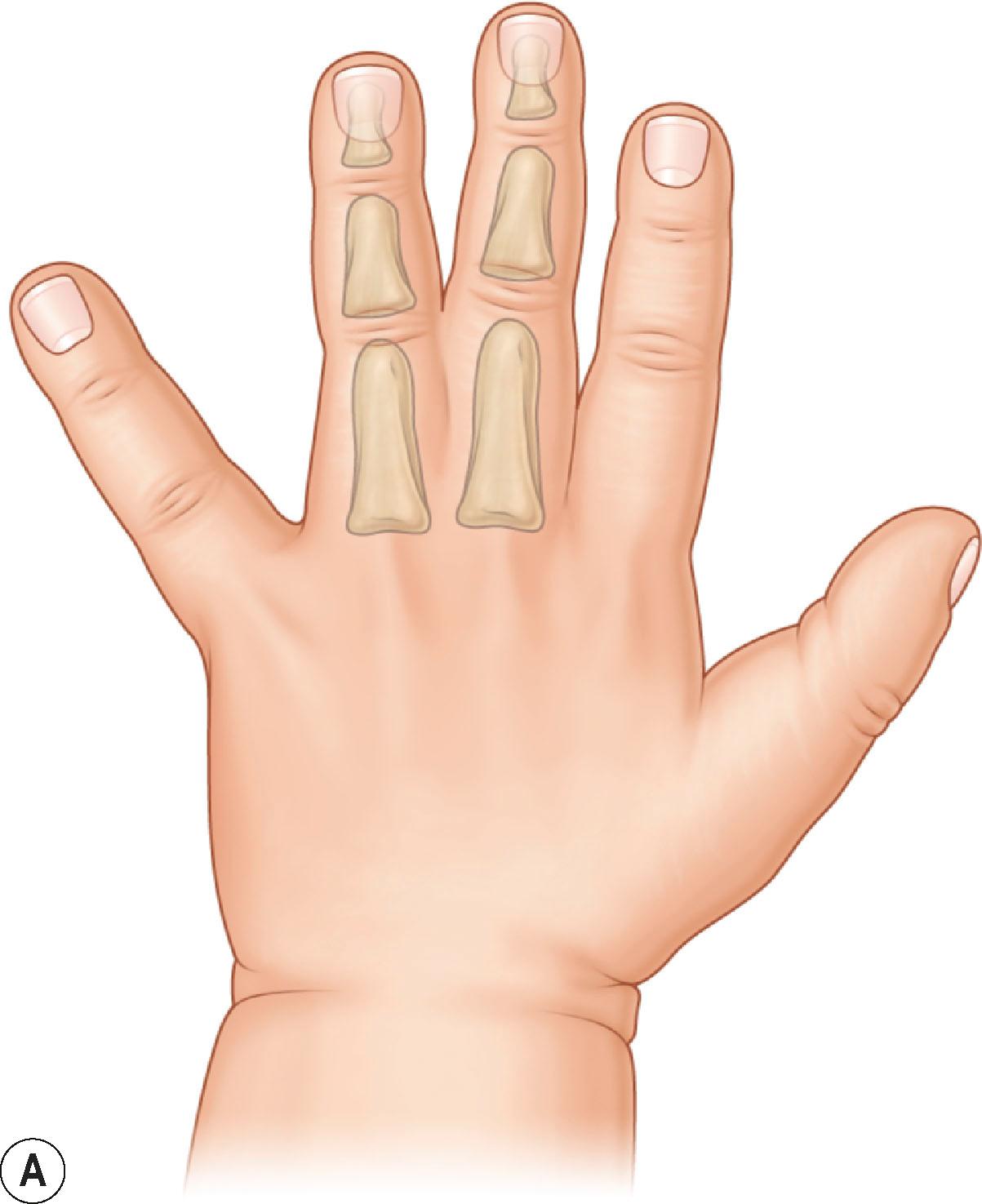 Figure 35.1, (A) Incomplete, (B) complete, (C) complex, and (D) complicated syndactyly.