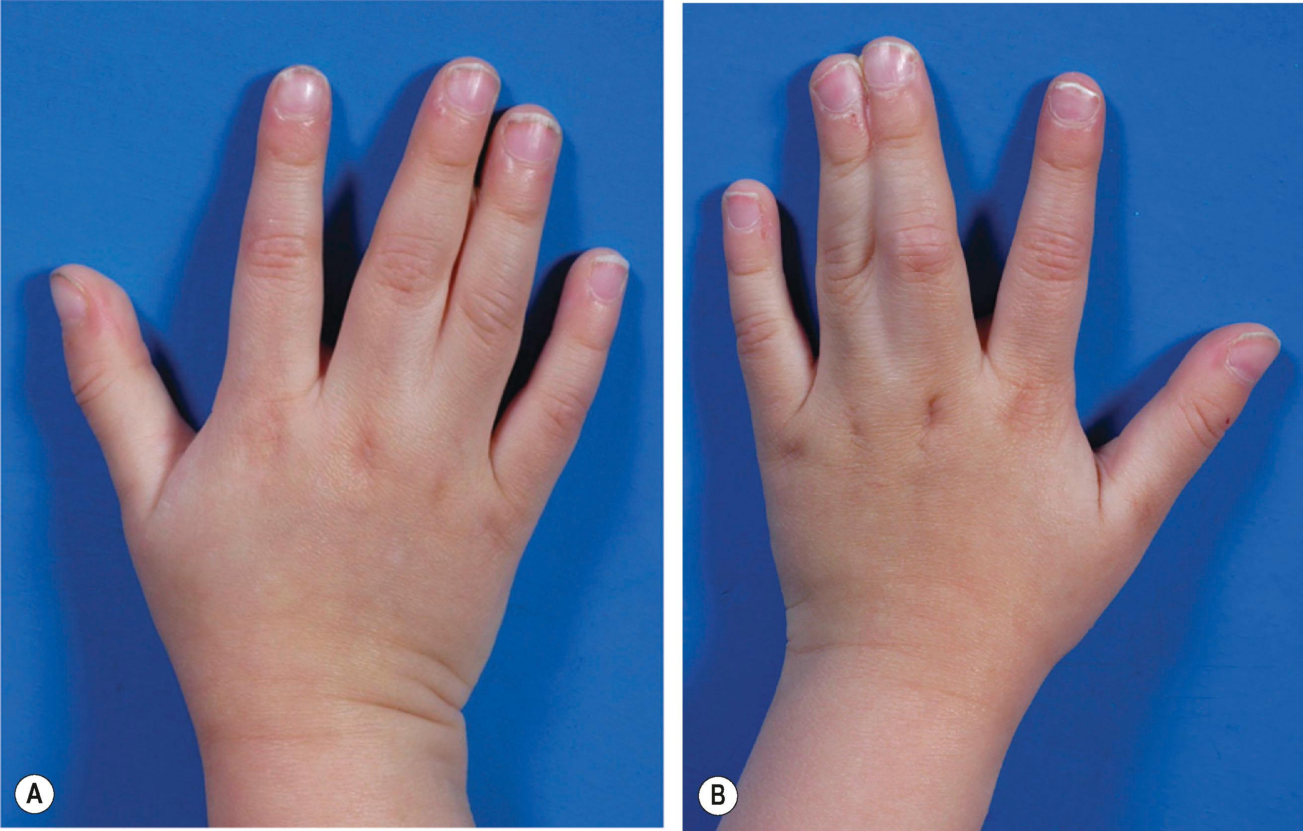 Figure 35.2, Incomplete syndactyly on the right hand and complete on the left in the same patient. (A) Pulp and nails are developed in a normal fashion. (B) Lateral nail folds on the syndactylized side are involved.