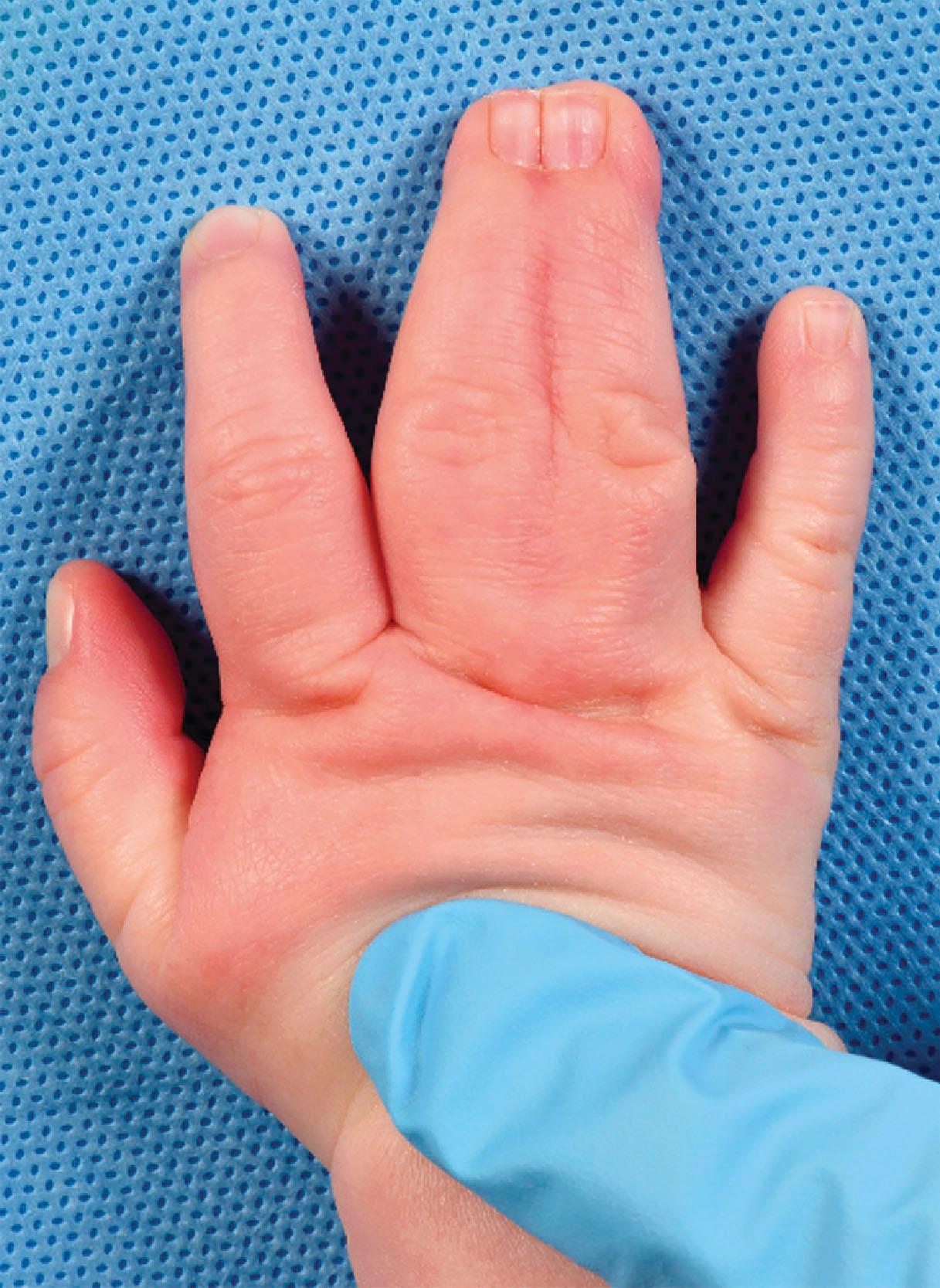 Figure 35.3, Complex syndactyly. The nails and distal phalanx are rotated and less wide. Pulp and lateral nail folds on the syndactylized side are involved. After release, a rotational defect can be expected.