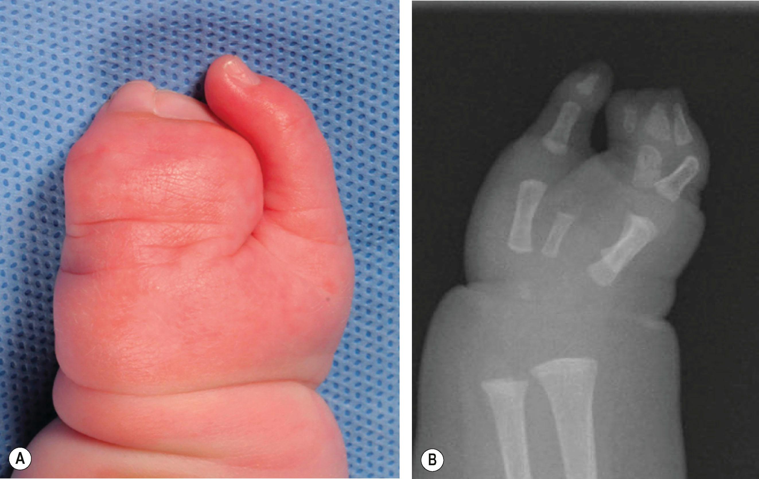 Figure 35.4, Complicated syndactyly. (A) Dorsal view. (B) Radiograph