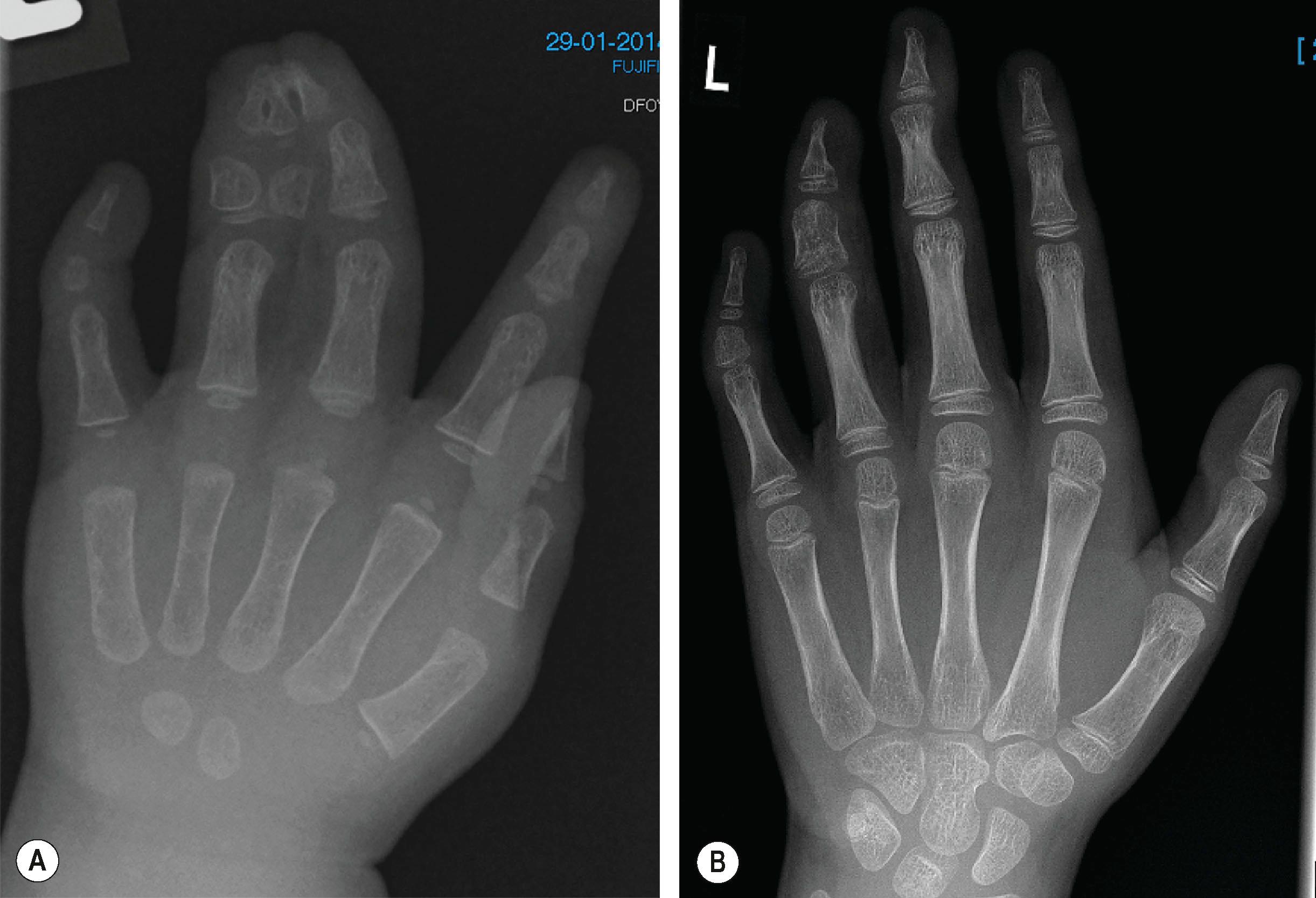 Figure 35.5, Polysyndactyly. (A) Preoperative radiograph. (B) Postoperative radiograph with removal of the polydactyly combined with the desyndactylization.