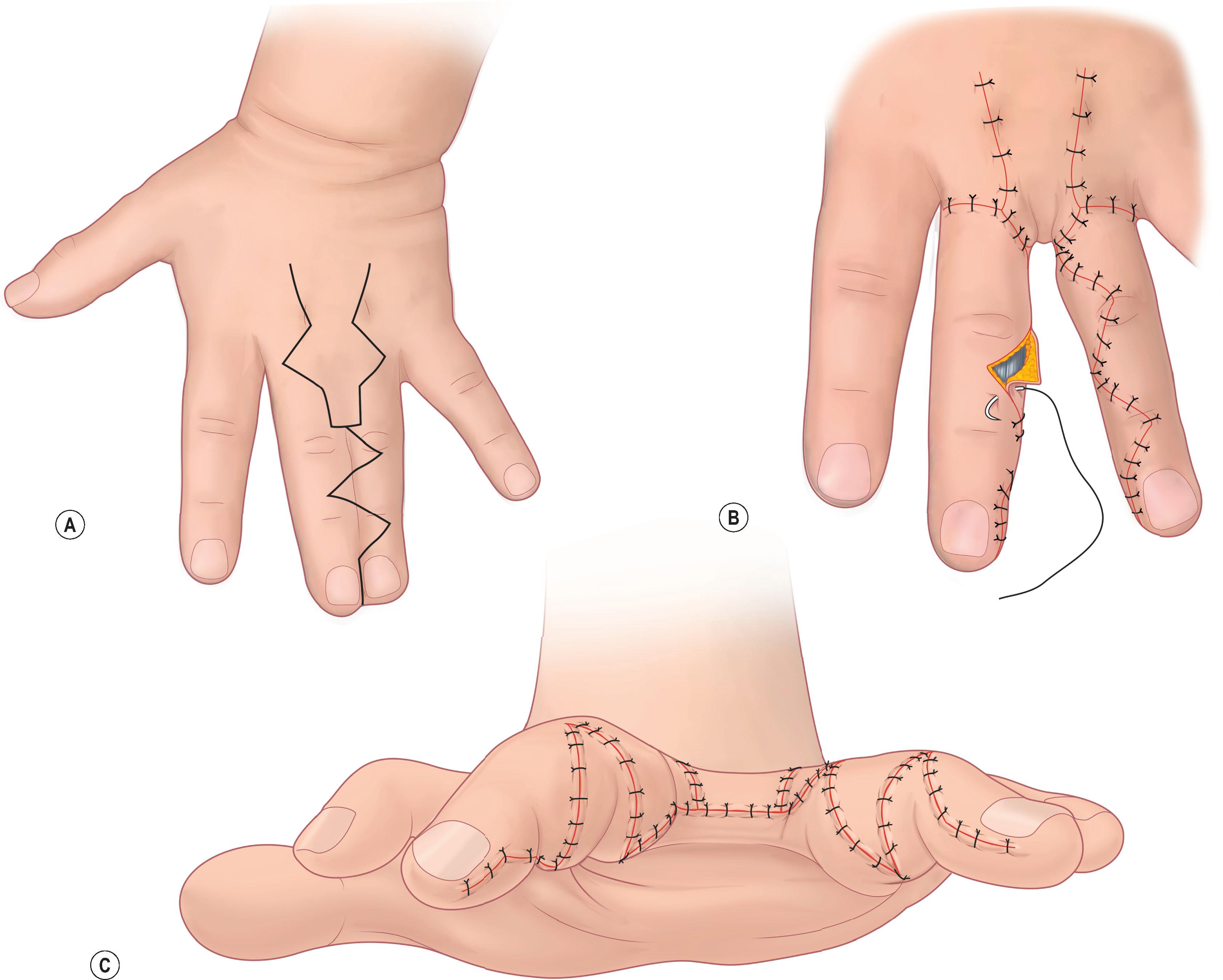 Figure 35.6, (A–C) Creation of webspace for repair of syndactyly.