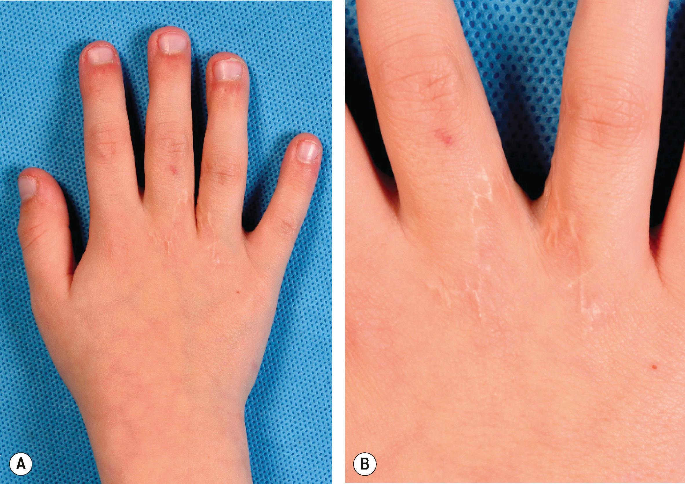 Figure 35.7, Two years after desyndactylization of an incomplete syndactyly of the third web. (A) Complete view. (B) Detail.