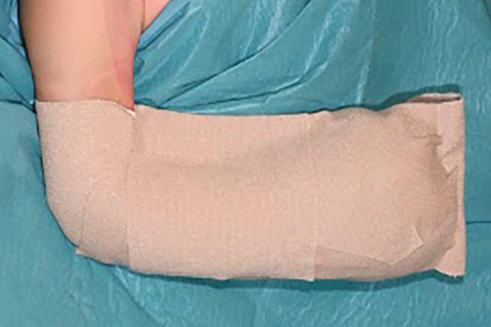 Figure 35.9, Author’s preferred bandage used after pediatric hand cases