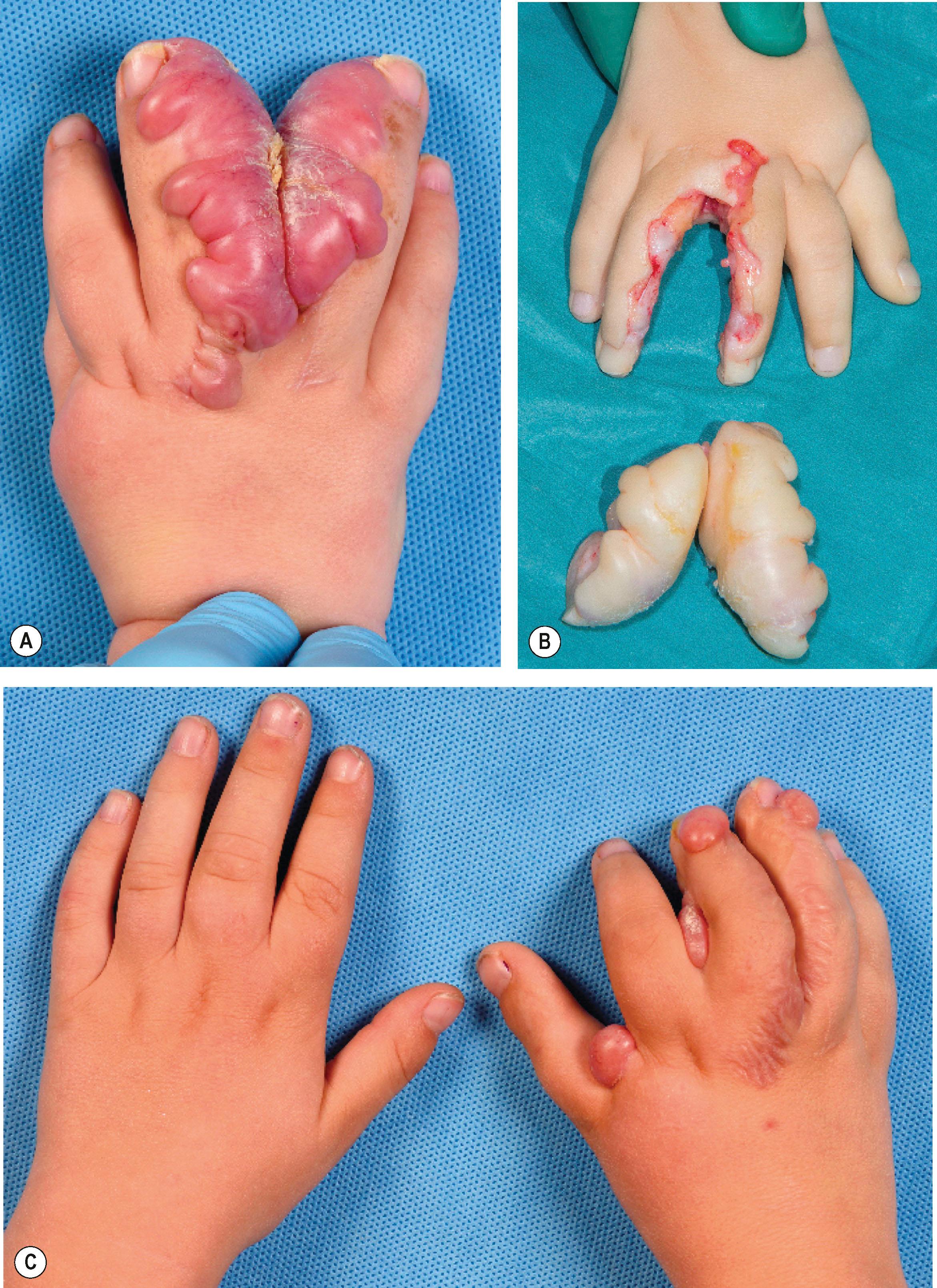 Figure 35.10, (A) Keloid after syndactyly release of the third web in a patient with an overgrowth syndrome. (B) Removal of keloid after institution of oral methotrexate. (C) Keloid formation under methotrexate, not caused by a surgical scar but after a superficial abrasion of the first web by a splint and of the fingers by a pressure glove, ironically to prevent keloid formation.