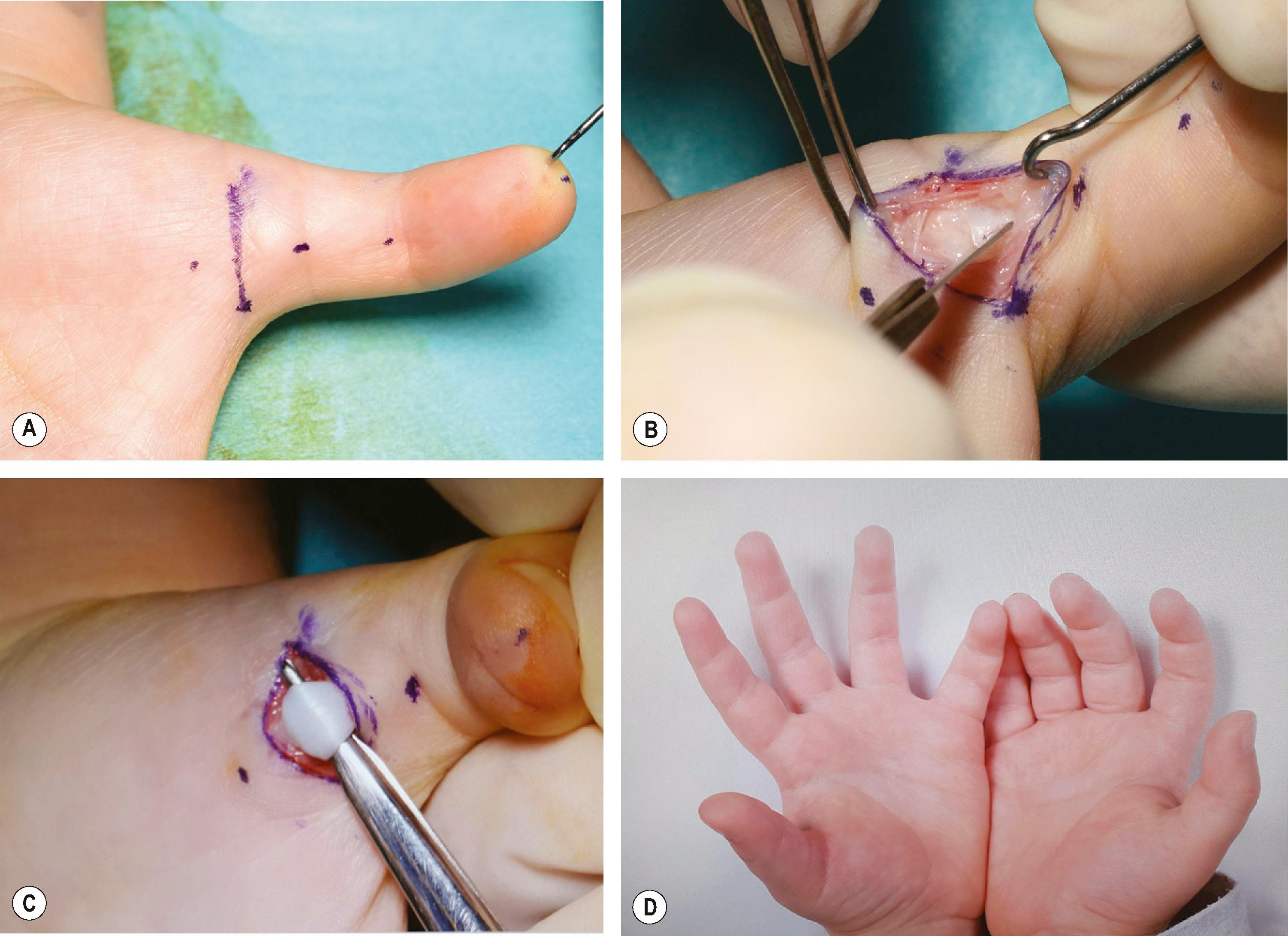 Figure 36.1, Steps in surgical release of pediatric trigger thumb. (A) Transverse crease incision. (B) Release of A1 pulley, initially with scalpel and then with scissors. (C) Check for full tendon excursion after pulley release. (D) Postoperative appearance at 3 months showing a completely straight left thumb with full range of motion.